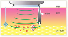 マイクロ波の周波数は、エネルギーが真皮を通過しやすく皮下脂肪で抵抗を受けるものが選択されています。