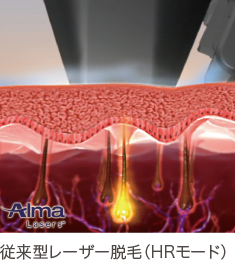 従来型レーザー脱毛（HRモード）