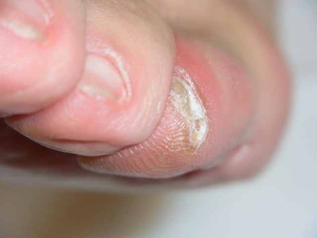 足 の 指 痛い 薬指