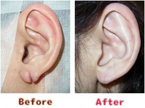耳垂裂治療の術前術後のイメージ10