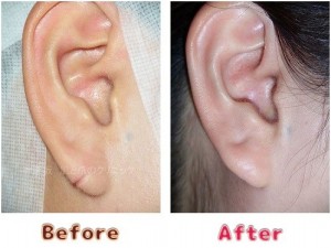 耳垂裂治療の術前術後のイメージ11
