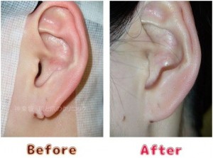 耳垂裂治療の術前術後のイメージ12