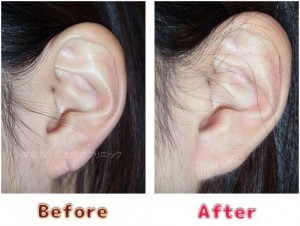 耳垂裂治療の術前術後のイメージ13