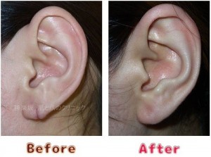 耳垂裂治療の術前術後のイメージ14