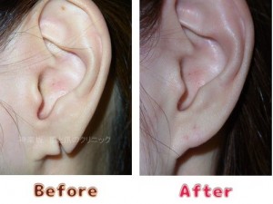 耳垂裂治療の術前術後のイメージ2