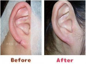 耳垂裂治療の術前術後のイメージ4