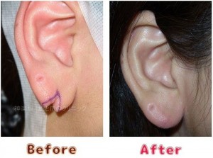 耳垂裂治療の術前術後のイメージ5