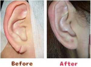 耳垂裂治療の術前術後のイメージ7
