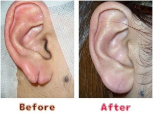 耳垂裂治療の術前術後のイメージ8
