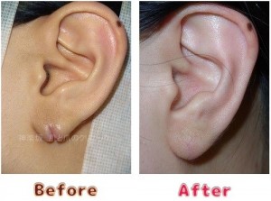 耳垂裂治療の術前術後のイメージ9