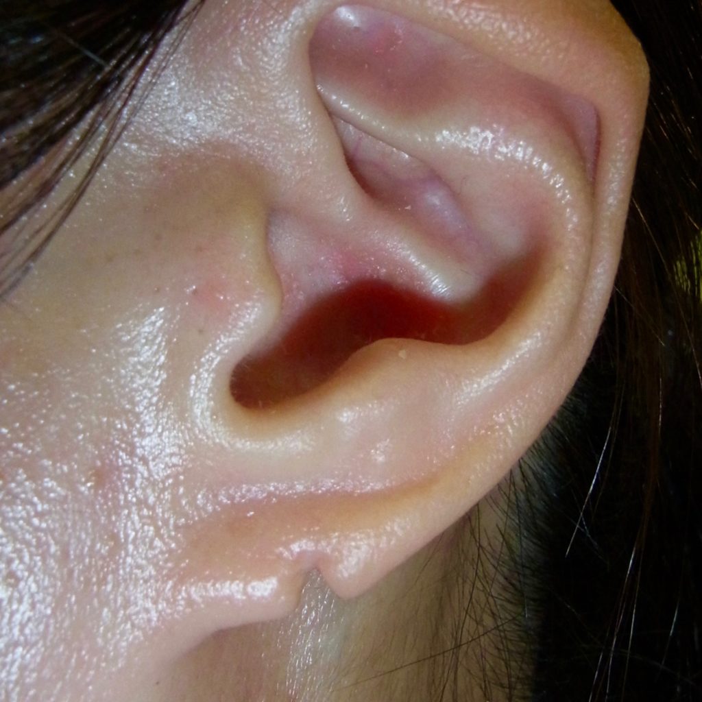 耳垂裂 ピアスによる耳切れ | 神楽坂肌と爪のクリニック