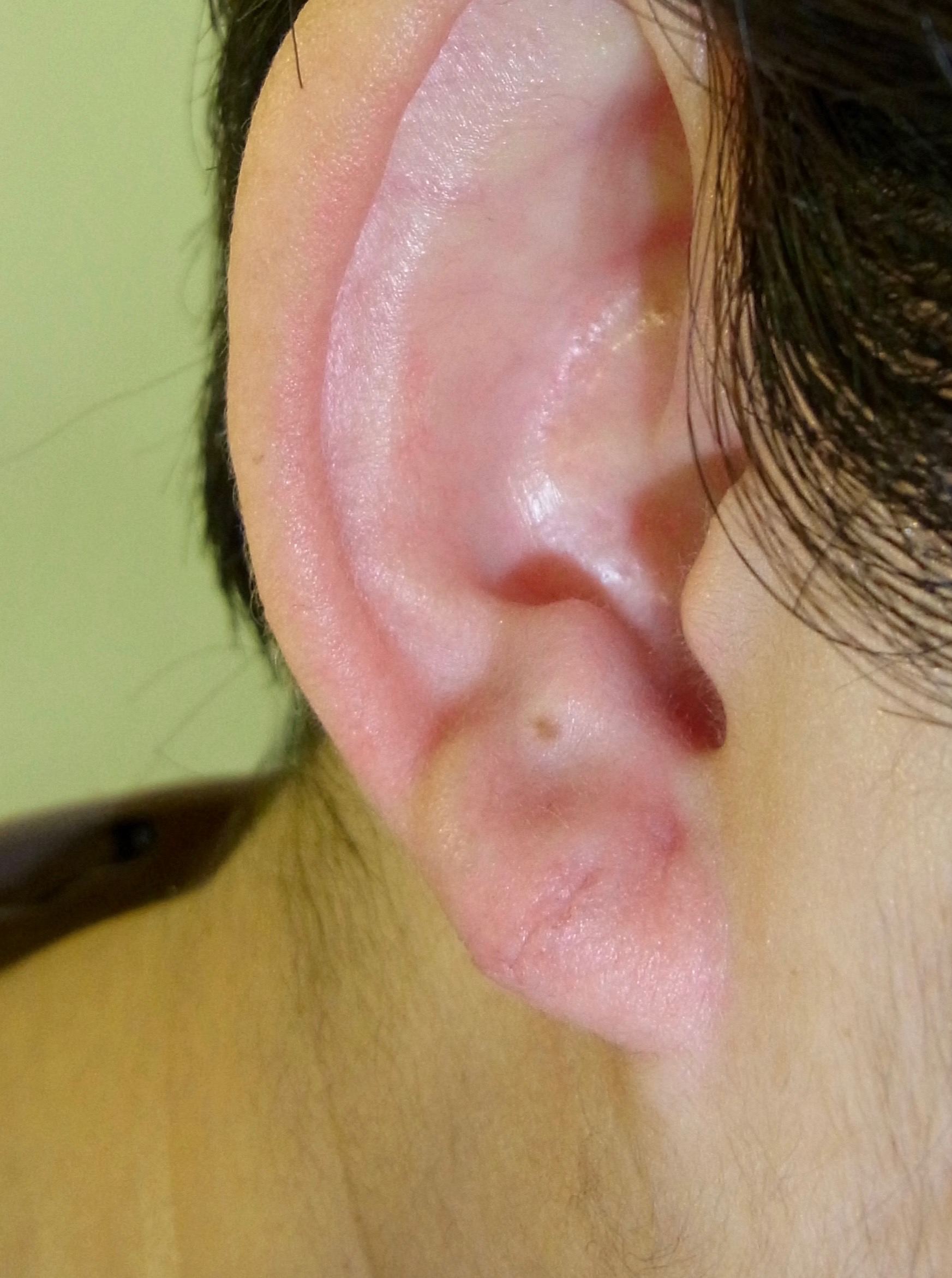 耳垂裂（じすいれつ） 耳の手術 | 神楽坂肌と爪のクリニック