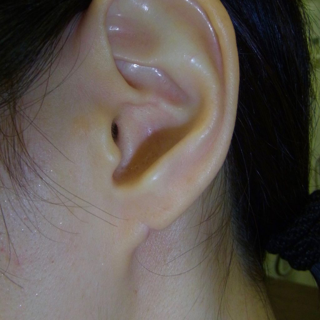 耳环选择不当，小心耳垂撕裂_耳部整形_疾病介绍_日常护理 - 好大夫在线