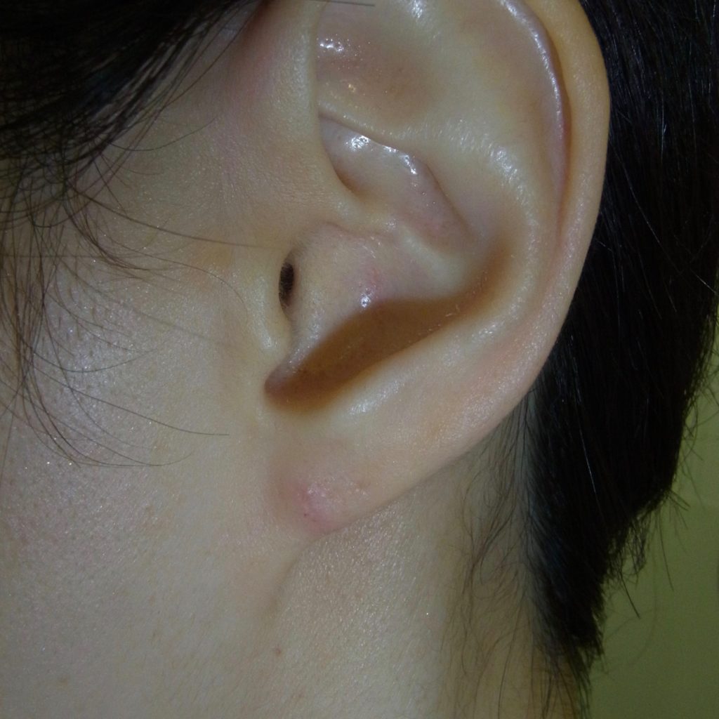 耳垂出現「褶痕」代表心血管出問題了？心臟科醫師解惑！ | 信傳媒