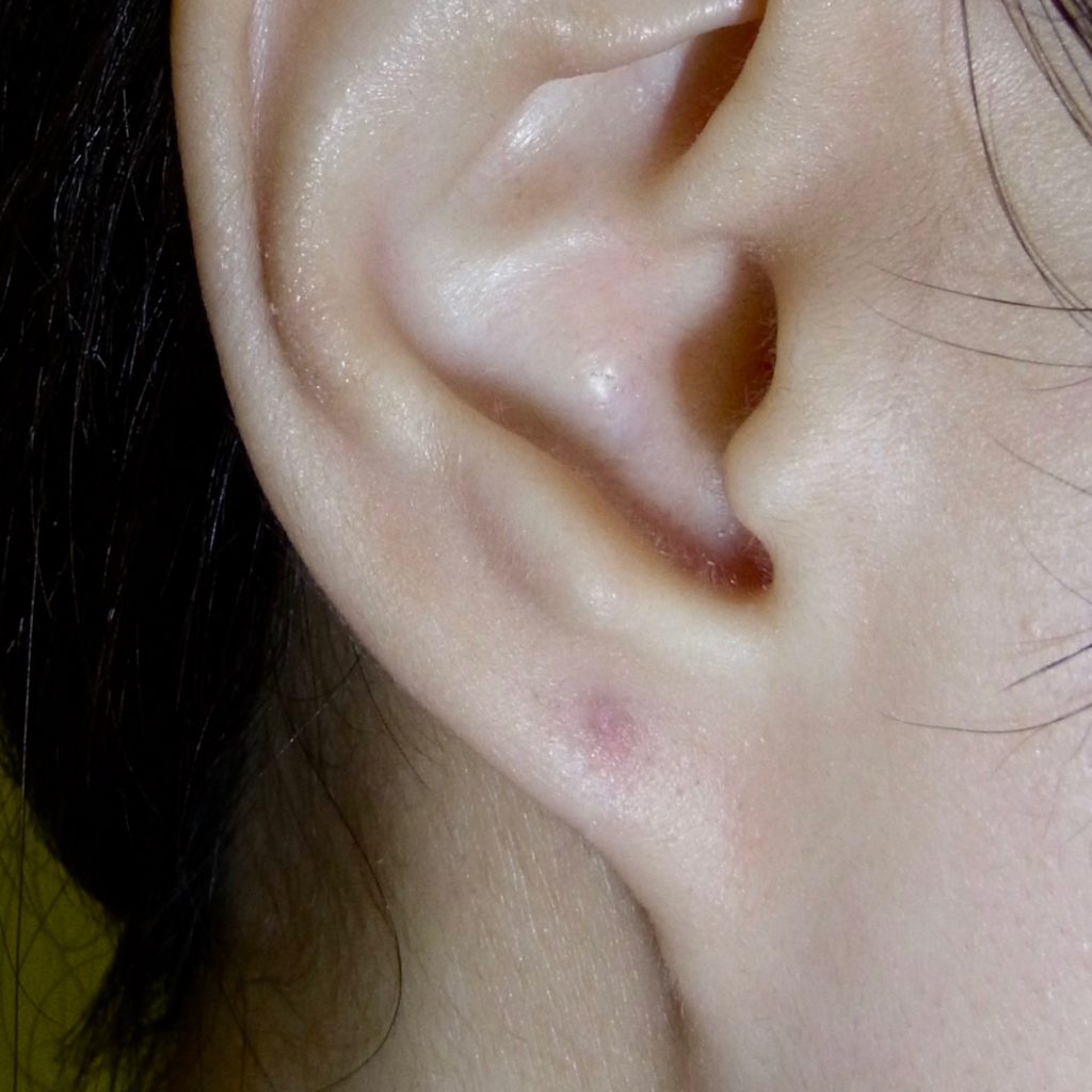 外傷性耳垂裂 ピアスによる耳切れ | 神楽坂肌と爪のクリニック