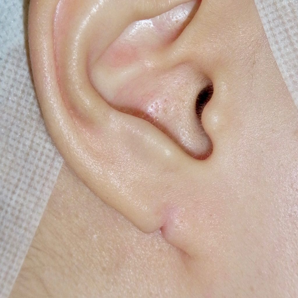 成人の副耳の手術です！ | 北千住静脈瘤クリニック