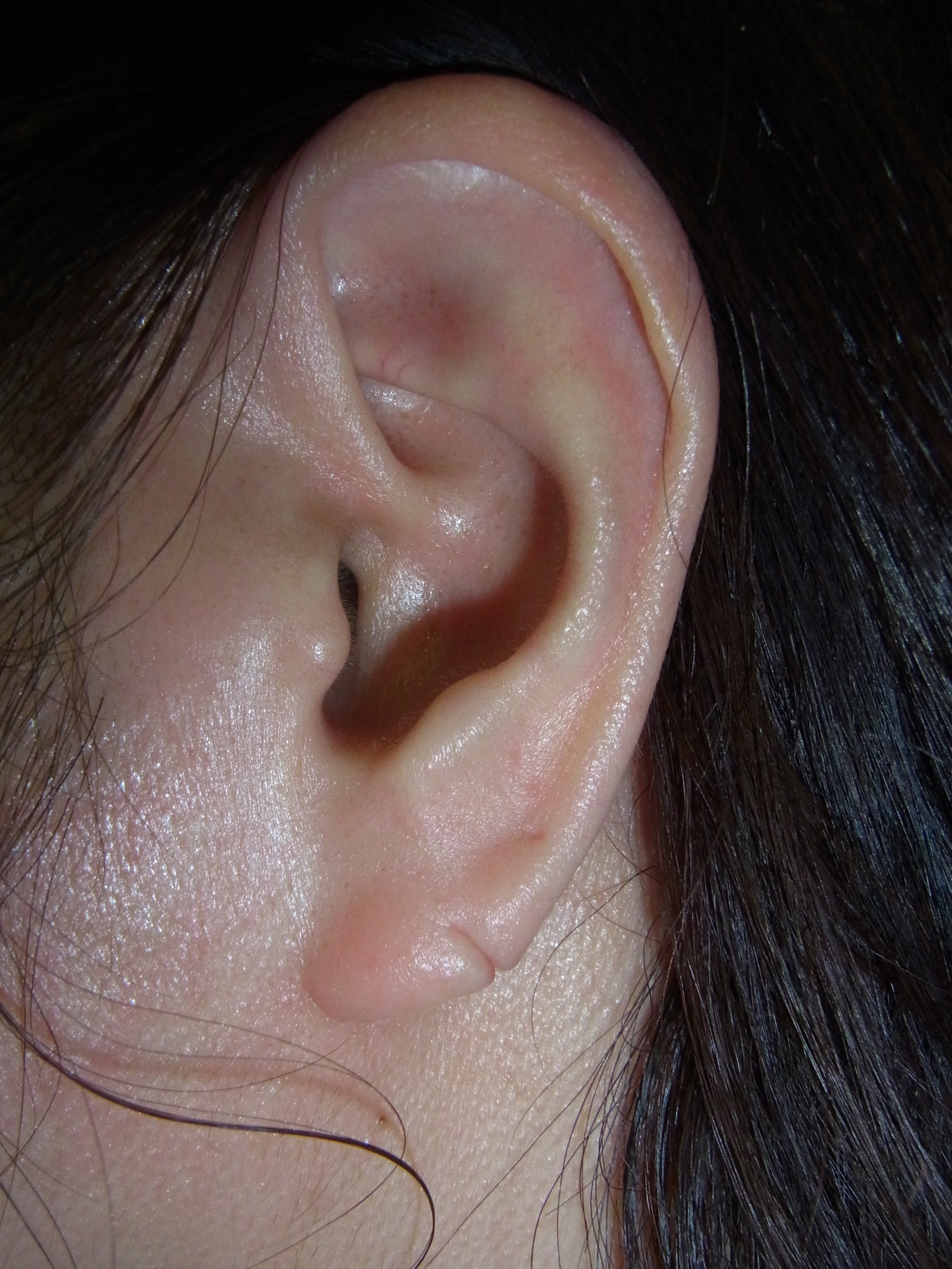 ピアスによる耳切れ耳垂裂がこんなにきれいになります 画像あり 神楽坂肌と爪のクリニック