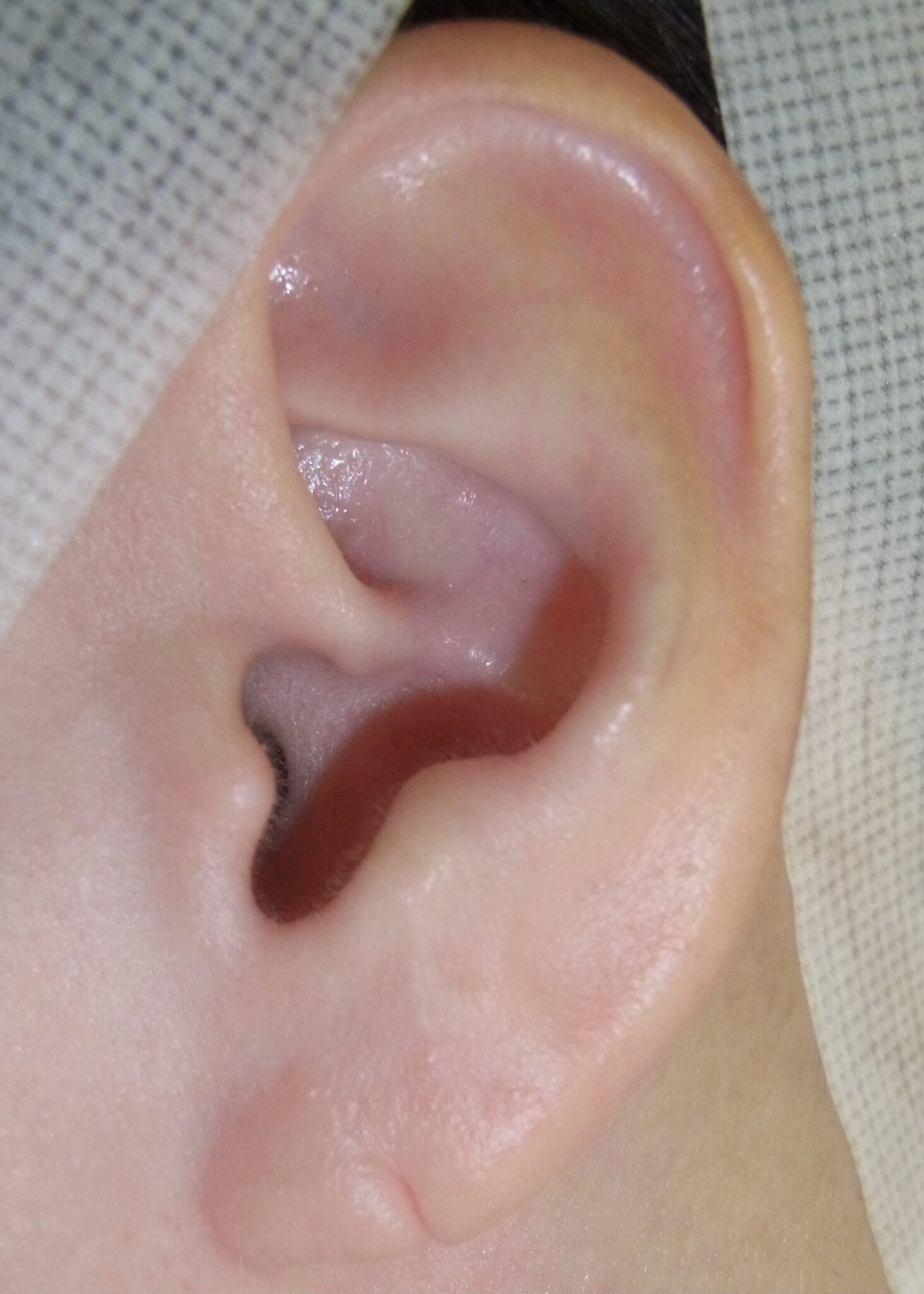 耳垂裂的手术治疗 - 好大夫在线
