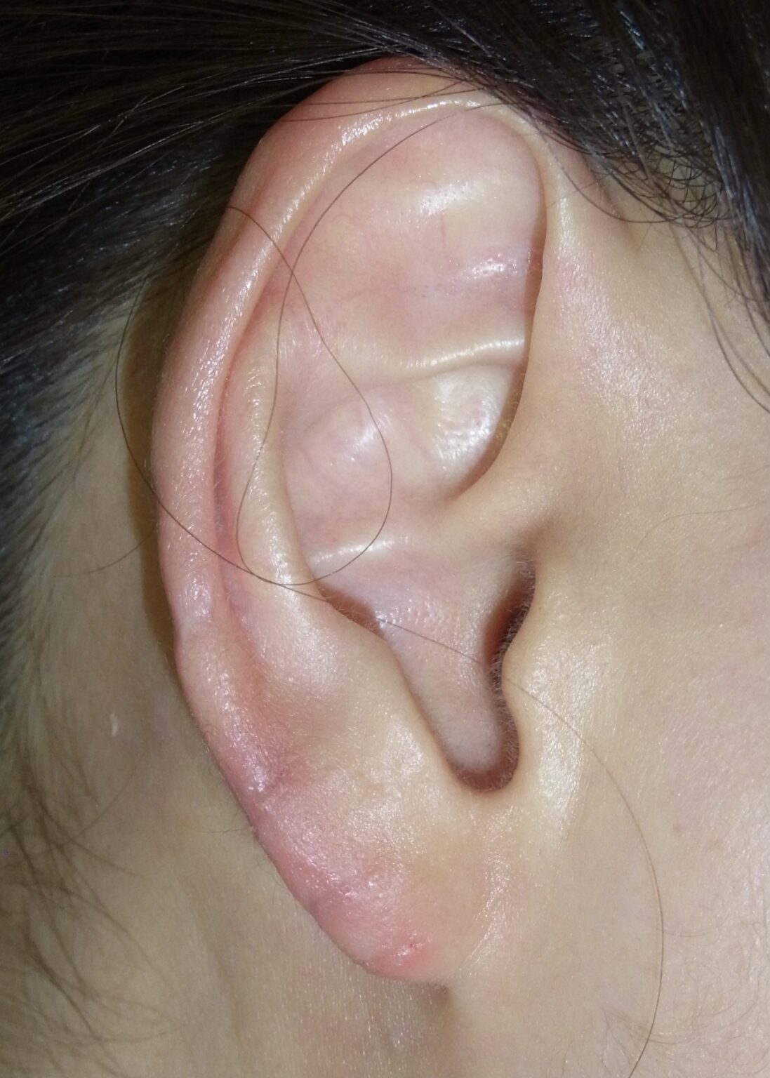 耳（耳垂裂 じすいれつ）の手術の術後経過 | 神楽坂肌と爪のクリニック
