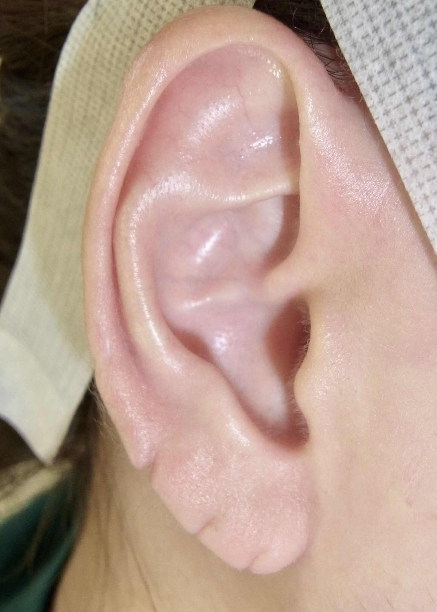 耳垂裂（じすいれつ）、耳切れの手術 | 神楽坂肌と爪のクリニック