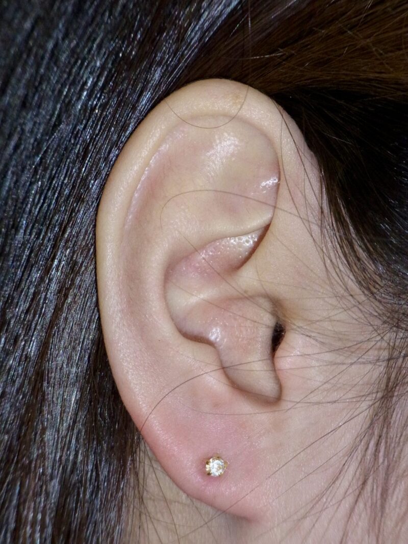 ピアスの穴あけは医療行為 なぜ？ | 神楽坂肌と爪のクリニック 