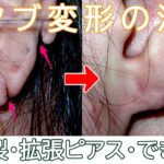 耳たぶ変形はここまで治せる【耳垂裂、拡張ピアス、ケロイド】