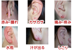 夏ピアスの常識が変わる？「化膿する」は過去の迷信か、2026年最新の皮膚科医リアル回答