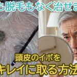 『頭皮のイボ』をシェービングでキレイに取る方法