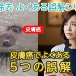 検証!皮膚癌でよくある5つの誤解【ほくろ除去の誤解シリーズ2】