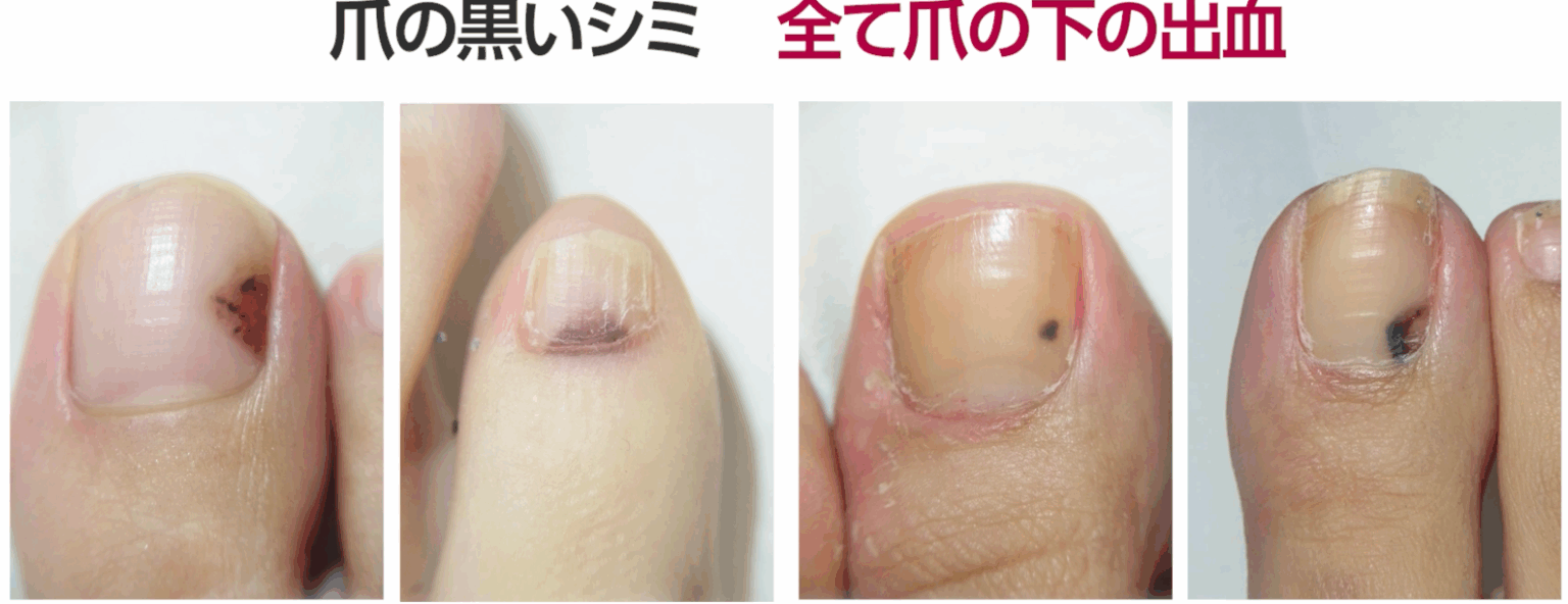 検証!皮膚癌でよくある5つの誤解【ほくろ除去の誤解シリーズ2】 | 神楽坂肌と爪のクリニック