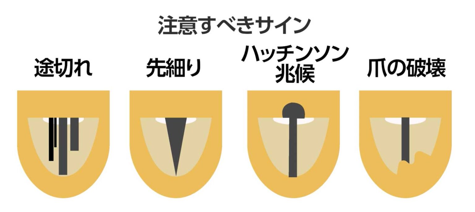 検証!皮膚癌でよくある5つの誤解【ほくろ除去の誤解シリーズ2】 | 神楽坂肌と爪のクリニック