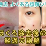 治療後の経過に関する誤解。症例写真はいつ撮影?【ほくろ除去の誤解シリーズ4】